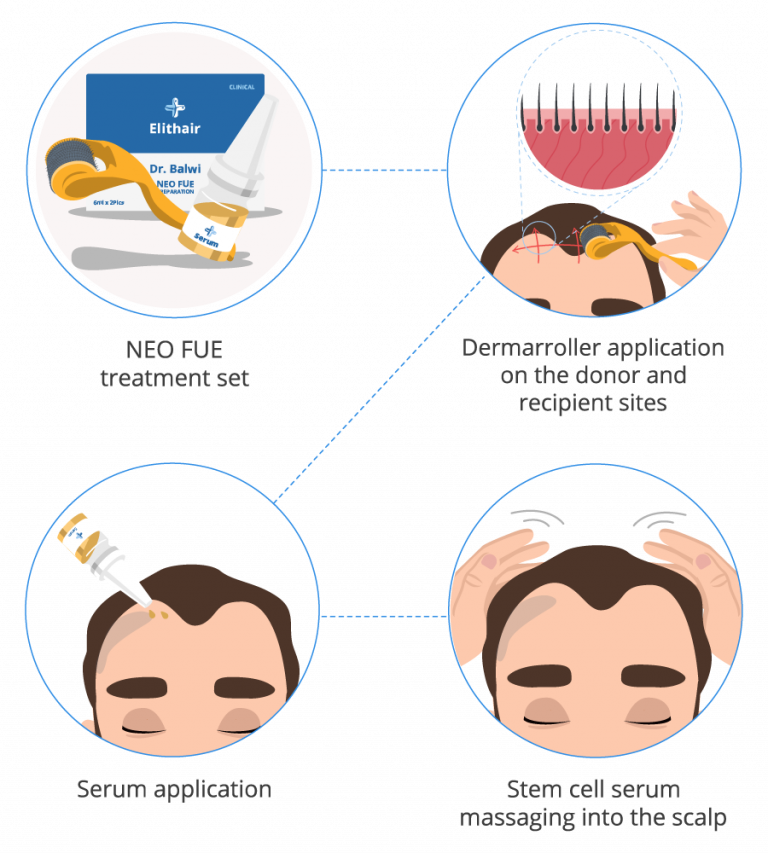 Neo Fue Ultimate Preparation For Your Hair Transplant Elithair