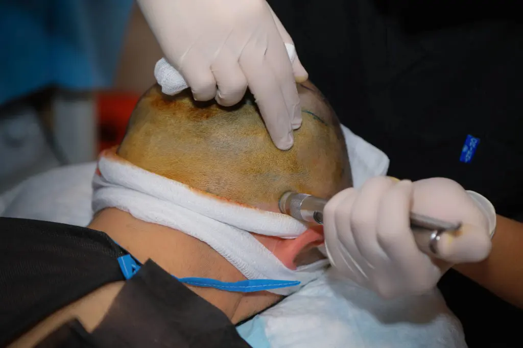 local anaesthesia is used for all our hair transplantation but they can on rare cases cause a hair loss after surgery