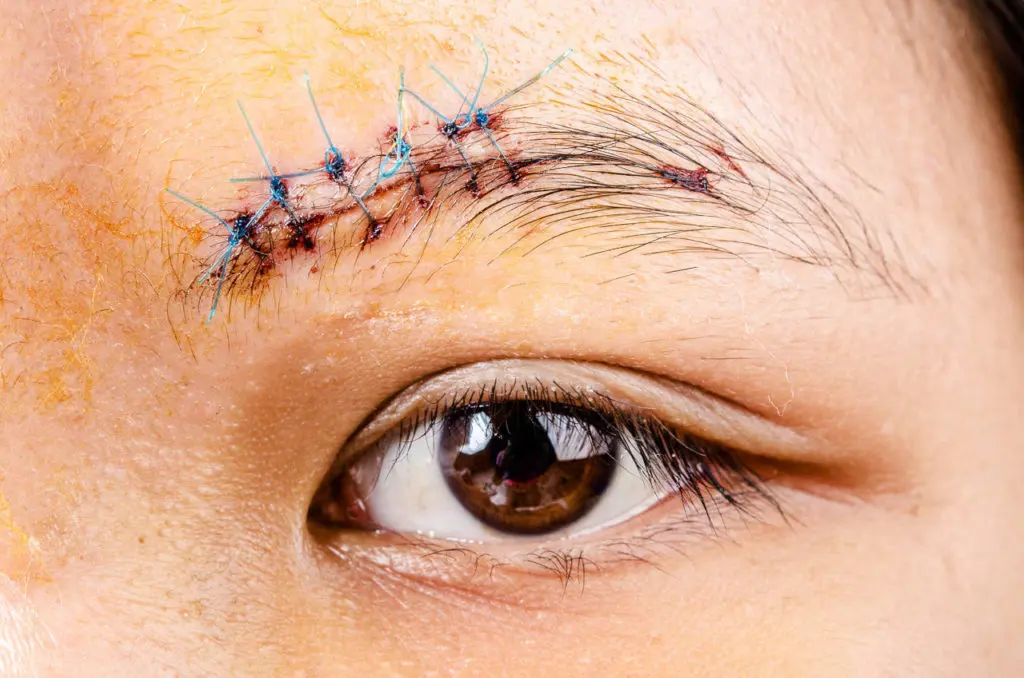 A hair transplant on scar within an eyebrow restores missing hairs