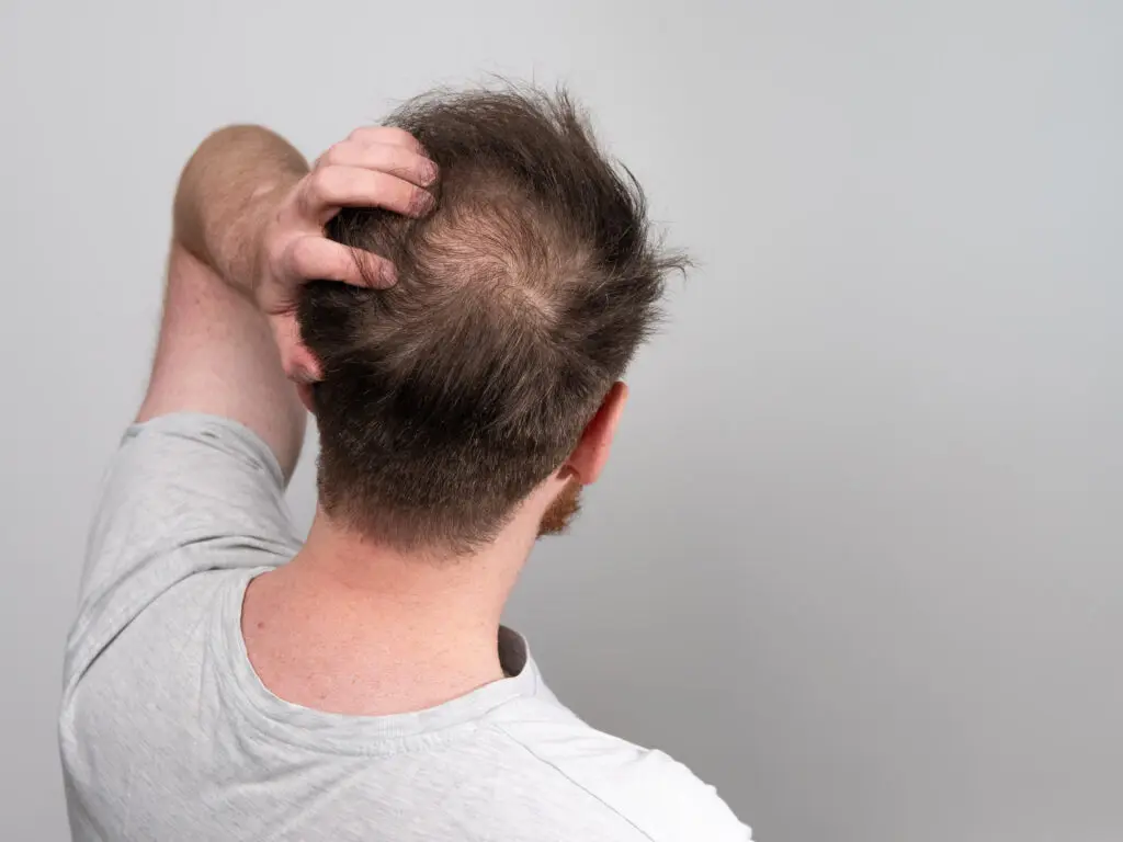 A man suffering from hair loss.