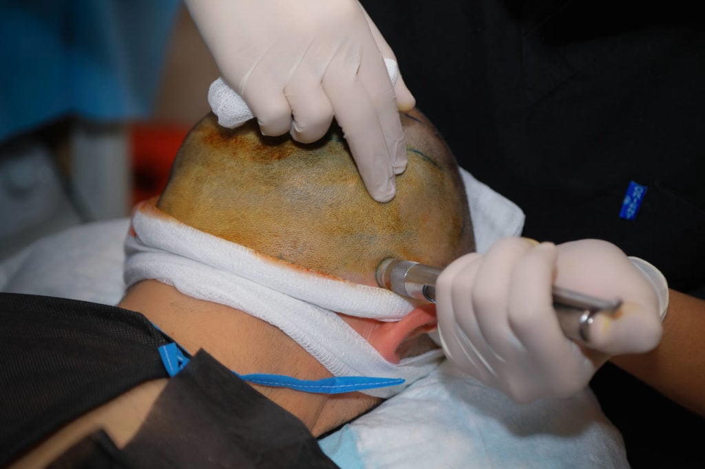 local anaesthesia is used for all our hair transplantation but they can on rare cases cause a hair loss after surgery
