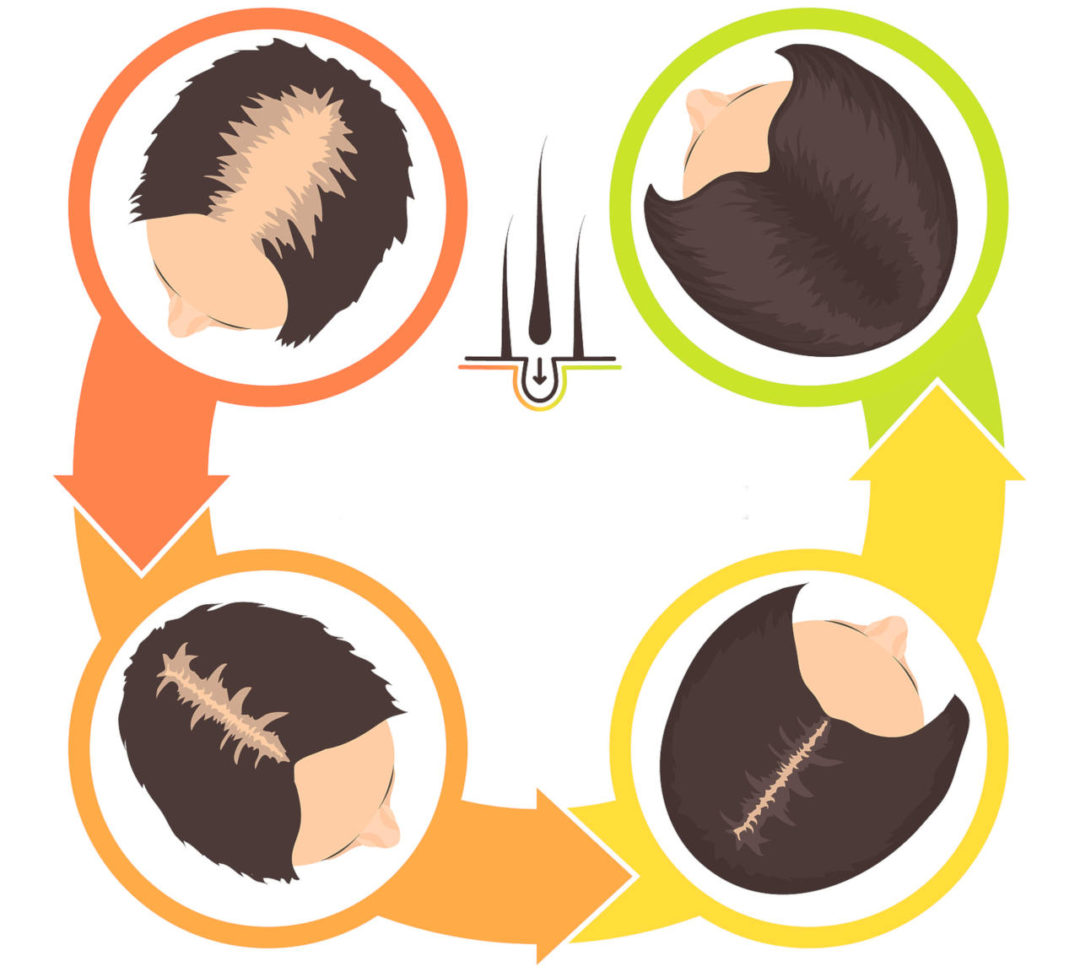 Hair Loss After Surgery Causes, 5 Ways to Reverse It Elithair