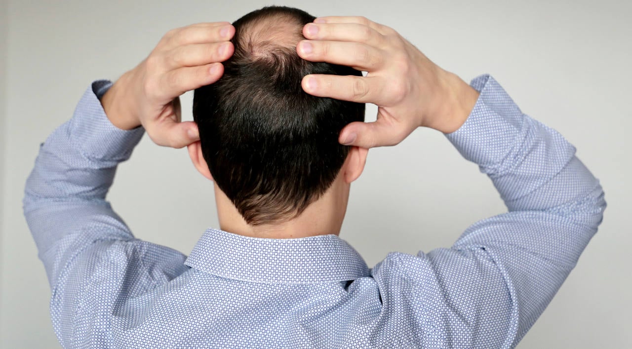 Female pattern baldness Information  Mount Sinai  New York