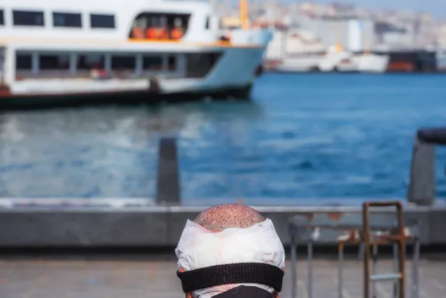 Picture of the scalp of a men who just had a hair surgery in Istanbul