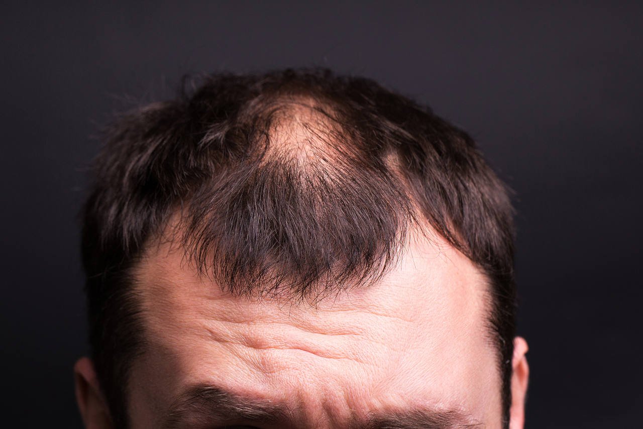 discover the causes of thinning hair that makes men go bald