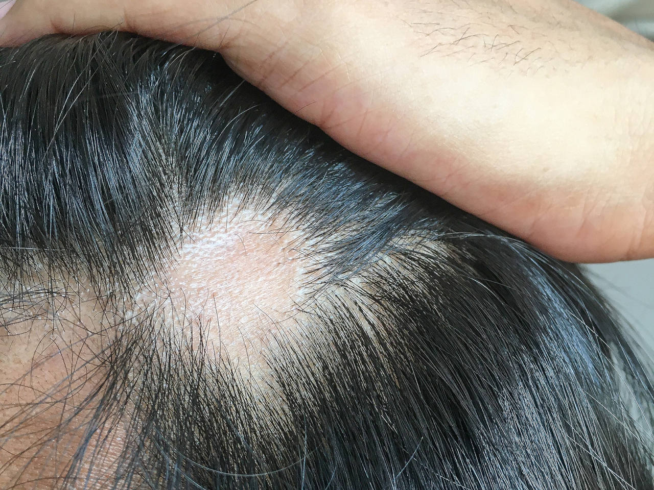 A scar on a scalp has caused a visible bald spot