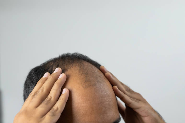 Close up of a man with a receding hair line caused by androgenic alopecia