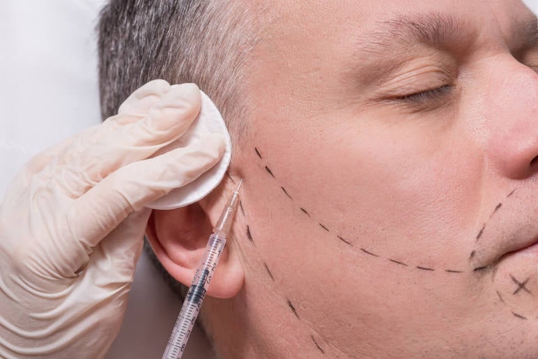 a man having a facial hair transplant