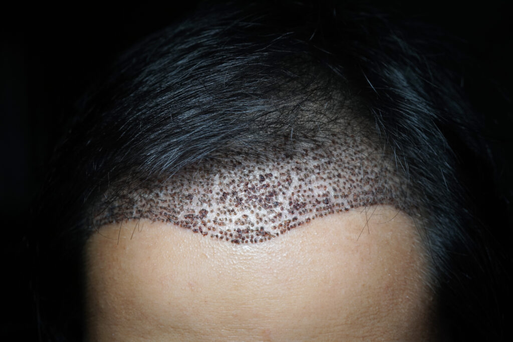 Hair Transplant procedure showing new hairline