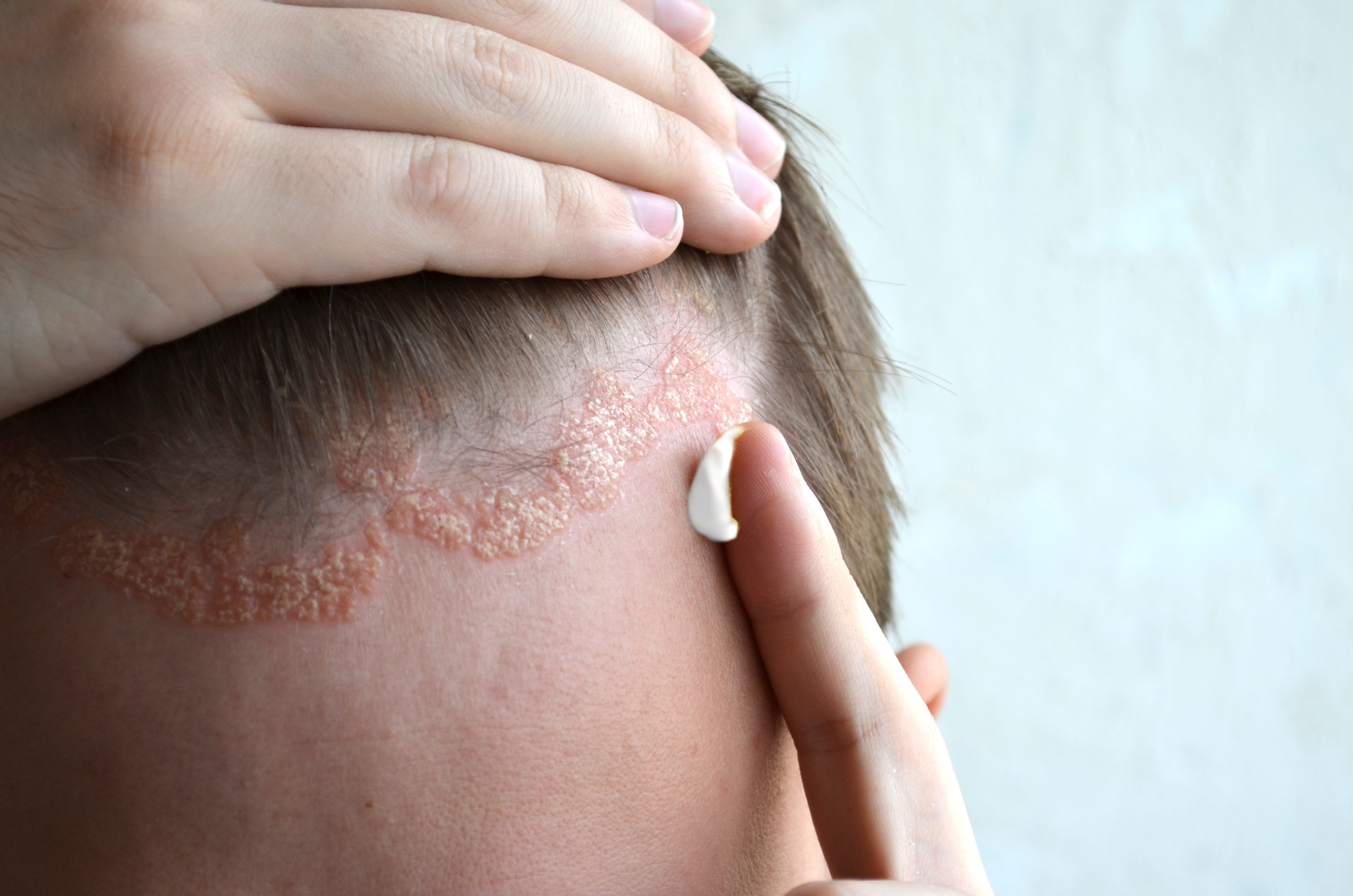 scalp-psoriasis-what-are-the-causes-and-treatments-elithair