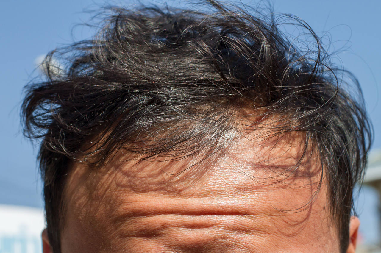 Why is my hair so thin and fragile? Elithairtransplant