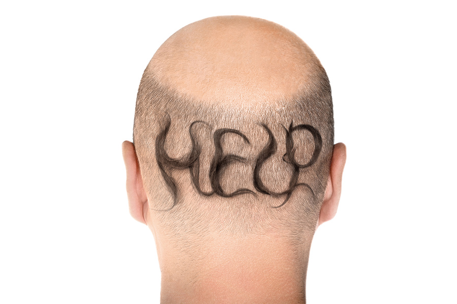 Back of head showing hair loss, hair spelling out help