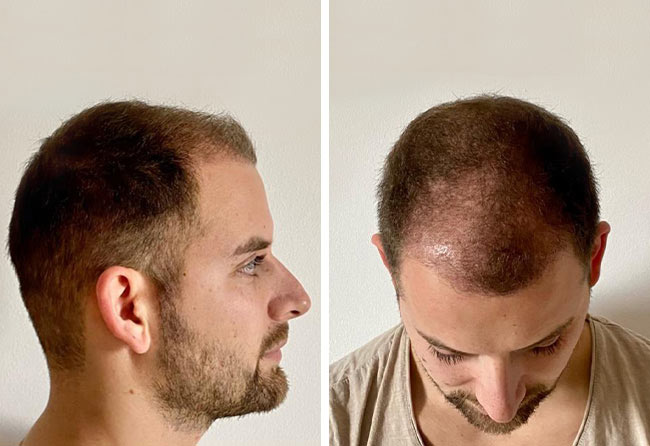 image after hair transplant 3 month fue sapphire 4200 grafts marcel oliva