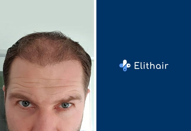 image after hair transplant fue sapphire 3 months 4100 grafts marcus medwed