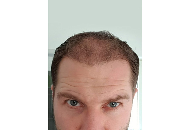 image after hair transplant fue sapphire 3 months 4100 grafts marcus medwed