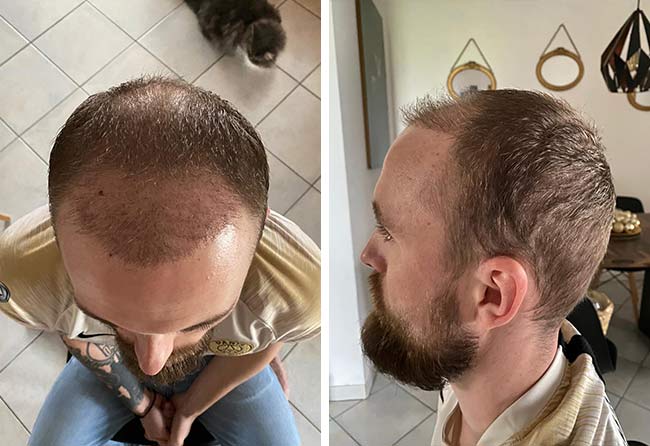 image after hair transplant fue sapphire 3700 grafts 2 months frederik g