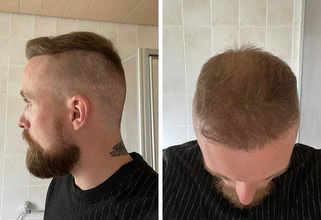 image after hair transplant fue sapphire 3700 grafts 6 months frederik g