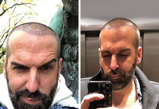 Image after hair transplant sapphire 3400 grafts 2 months juergent.