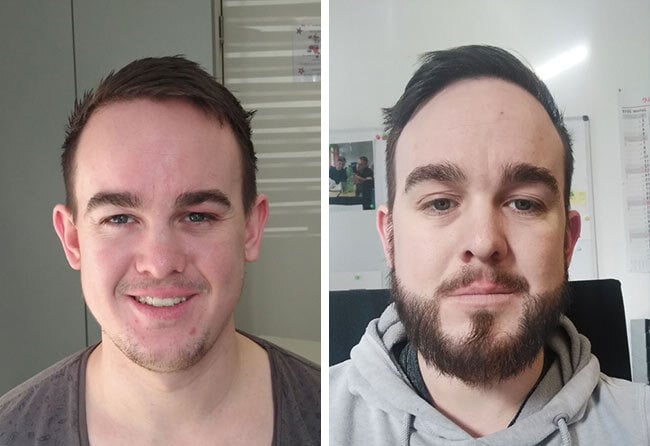 image before after beard implant sapphire 4300 grafts oliver dyllick