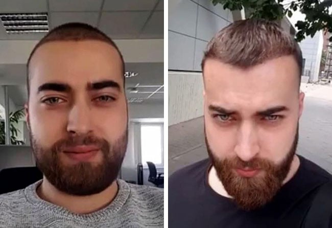 Image before after beard transplant sapphire 4250 grafts 4 month andre ulbrich