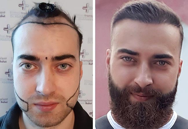 image before after beard transplant sapphire 4250 grafts andre ulbrich