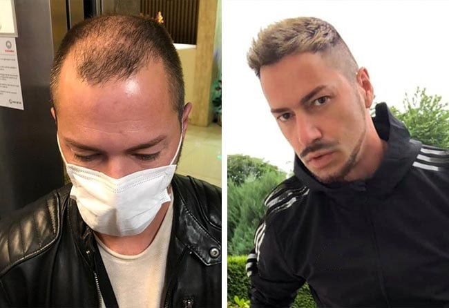 image before after hair transplant DHI 5200 grafts andre osiander