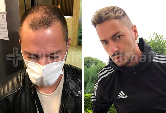 image before after hair transplant DHI 5200 grafts andre osiander