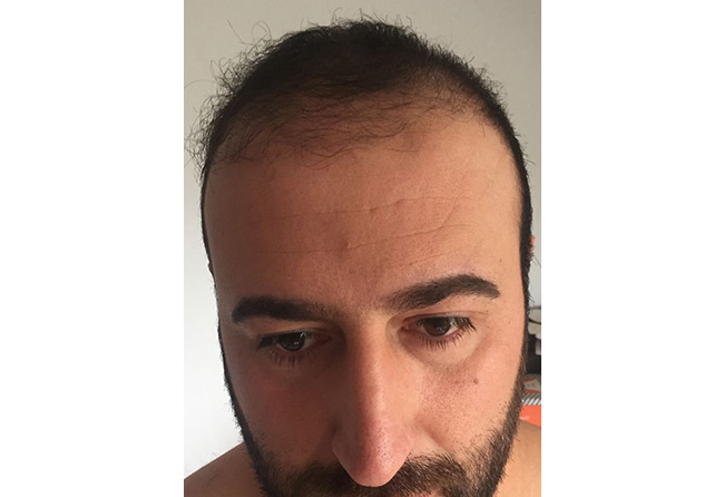 image before after hair transplant fue sapphire 3500 grafts 3 months artin asrian