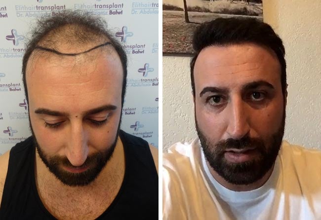 image before after hair transplant fue sapphire 3500 grafts artin asrian