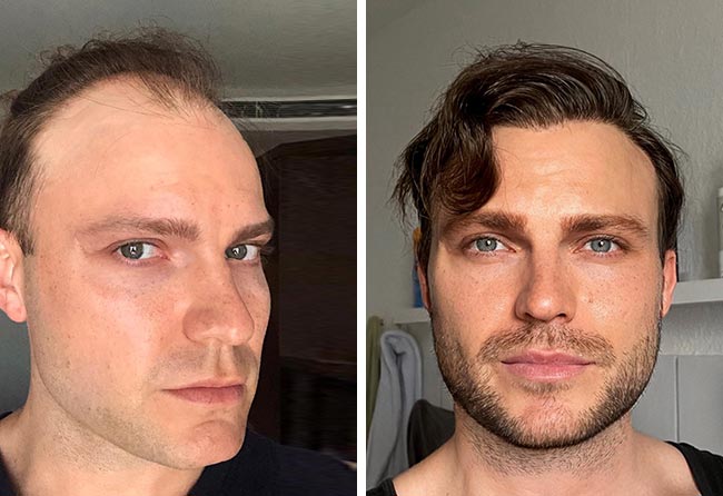 Before after picture for the sapphire fue hair transplant with 3700 grafts of Eddie N.