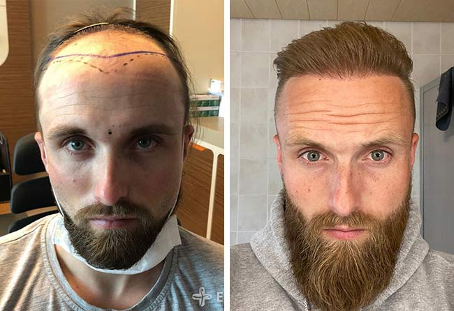 before after hair transplant fue sapphire 3700 grafts frederik g