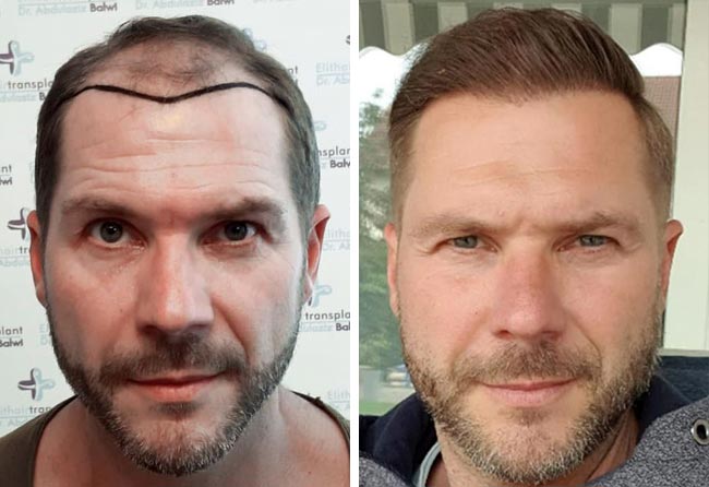 image before after hair transplant fue sapphire 4100 grafts marcus medwed
