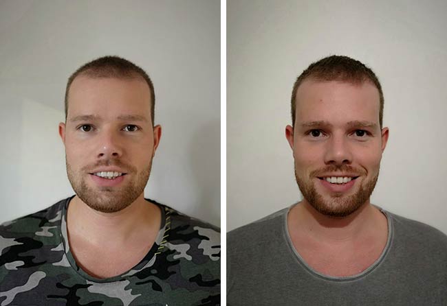 image sapphire hair transplant result with 2800 grafts by Alexander Kitzel after 3 months