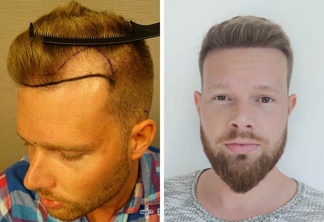 Before and after image sapphire FUE hair transplant with 2800 grafts by Alexander Kitzel
