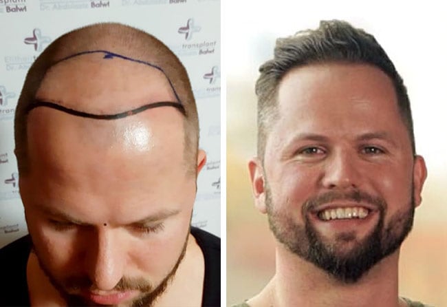 image before after hair transplant sapphire 3200 grafts nico gumlich