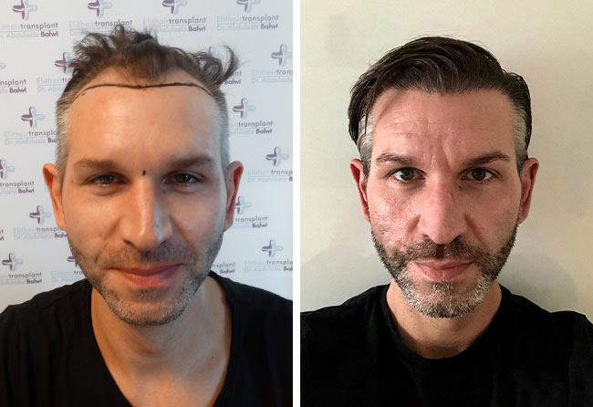 image before after hair transplant sapphire fue 4250 grafts thomas schreier