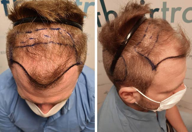 image before hair transplant 4500 grafts kewin lenzing