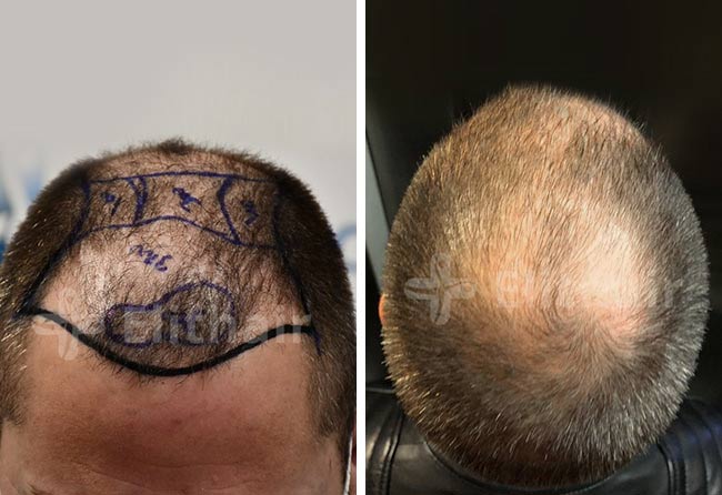 image before hair transplant DHI 5200 grafts andre osiander