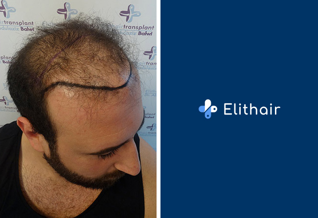 image before hair transplant fue sapphire 3500 grafts artin asrian