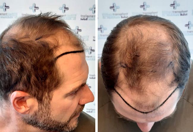 image before hair transplant fue sapphire 4100 grafts marcus medwed