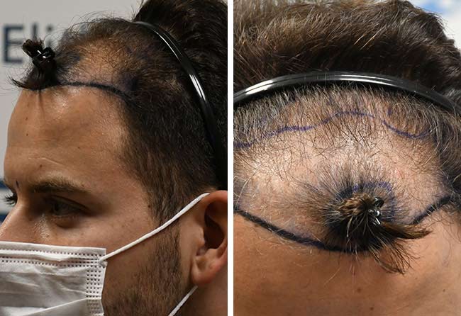 image before hair transplant fue sapphire 4200 grafts marcel oliva