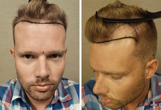 Image before FUE sapphire hair transplant with 2800 grafts by Alexander Kitzel
