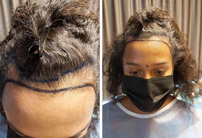 image before hair transplant women SDHI 2700 grafts melissa zerhau