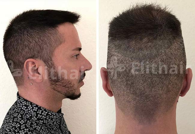Image result hair transplant DHI 5200 grafts andre osiander