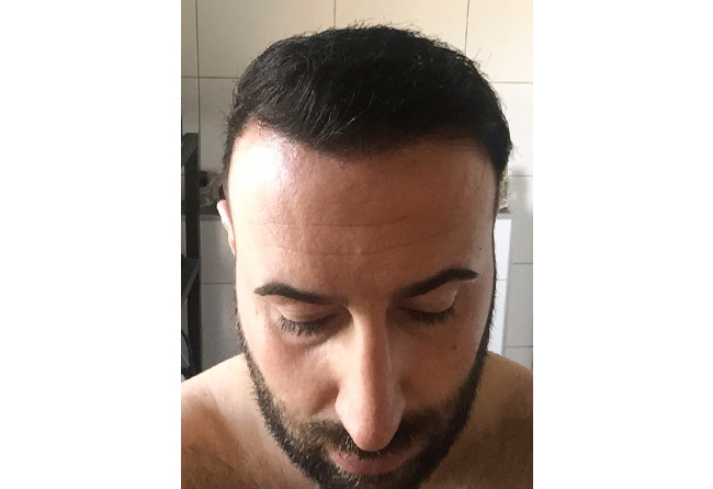 Image result hair transplant fue sapphire 3500 grafts artin asrian