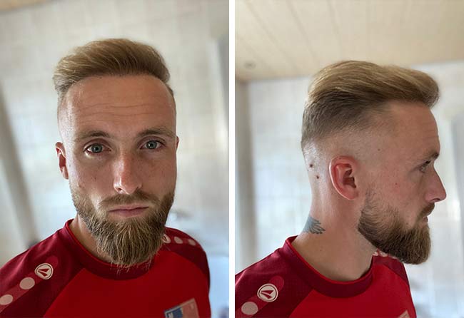 Pictures of Frederik, an Elithair patient, showing the final result of his hair transplant
