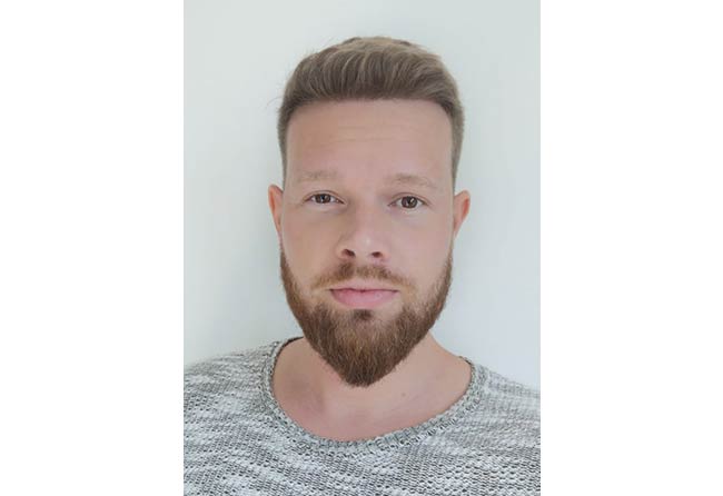 image result sapphire FUE hair transplant with 2800 grafts by Alexander Kitzel