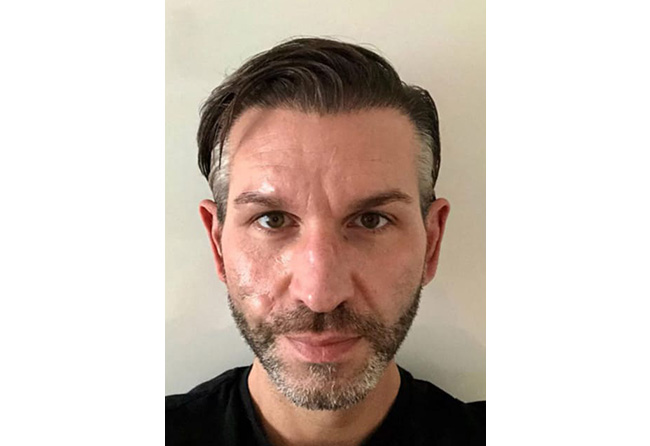 image result hair transplant sapphire fue 4250 grafts thomas schreier