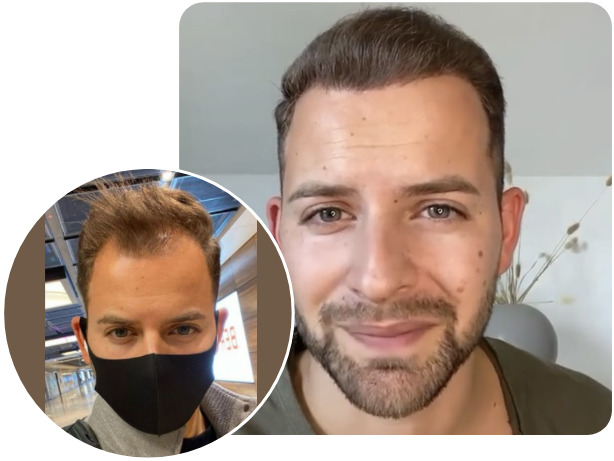 Before and after NEO FUE hair transplant patient with 4200 grafts