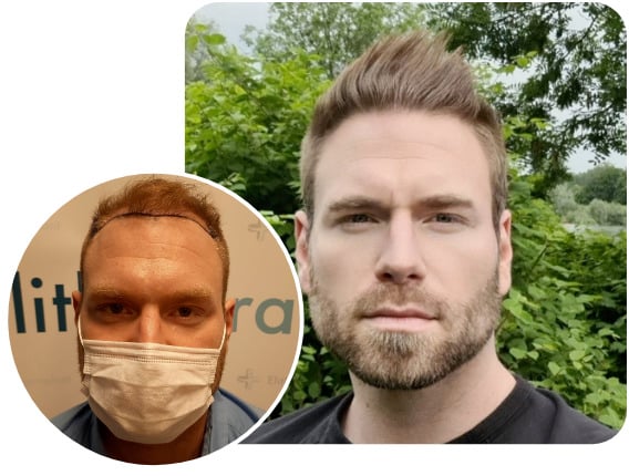 Elithair hair transplant patient after 4000 grafts with sapphire hair transplant
